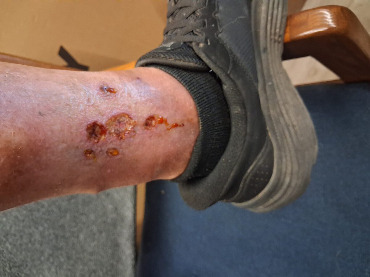 Left ankle wound — baseline Day 1, August 8 2026