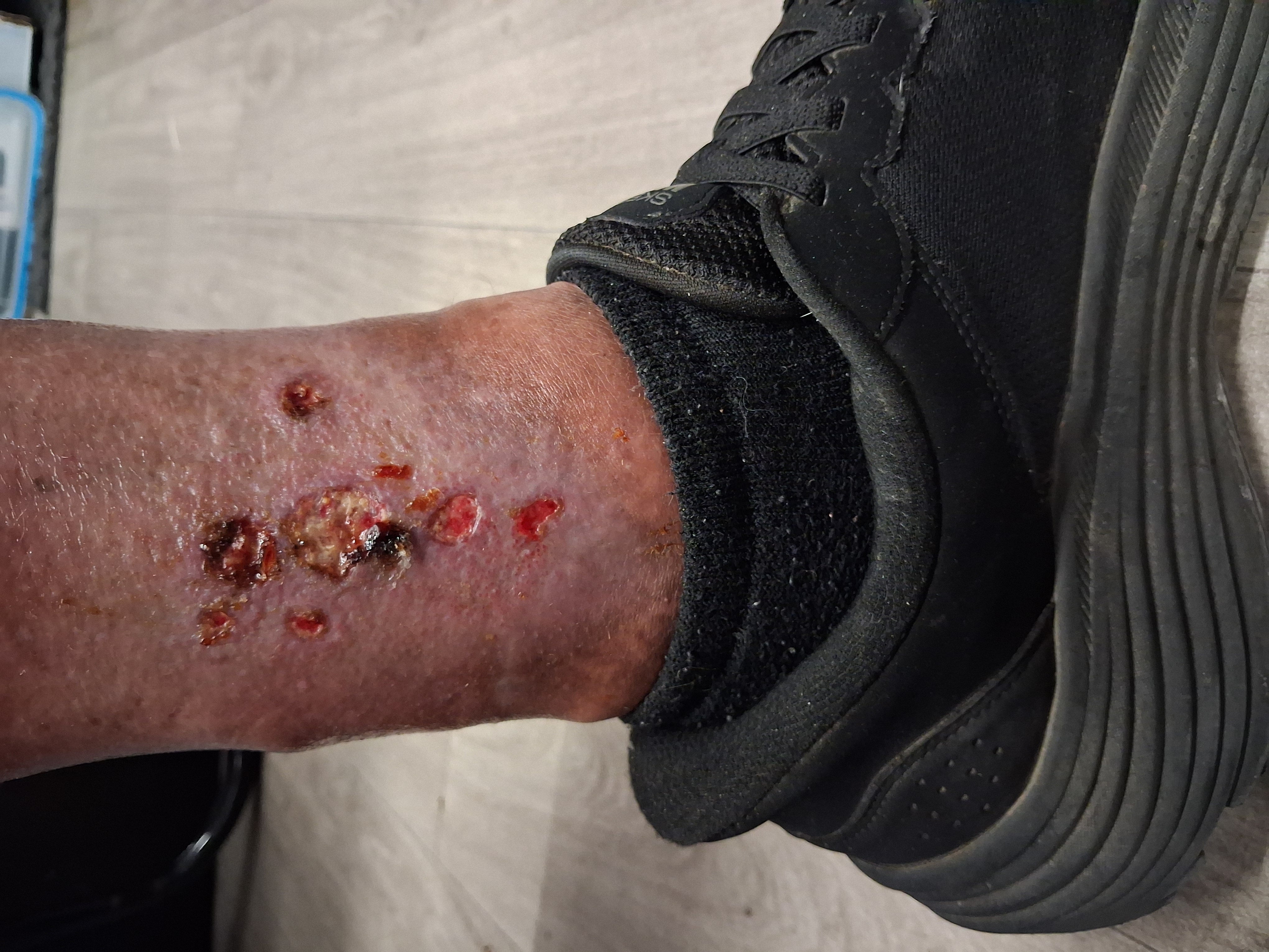 Left ankle wound, end of Week 2