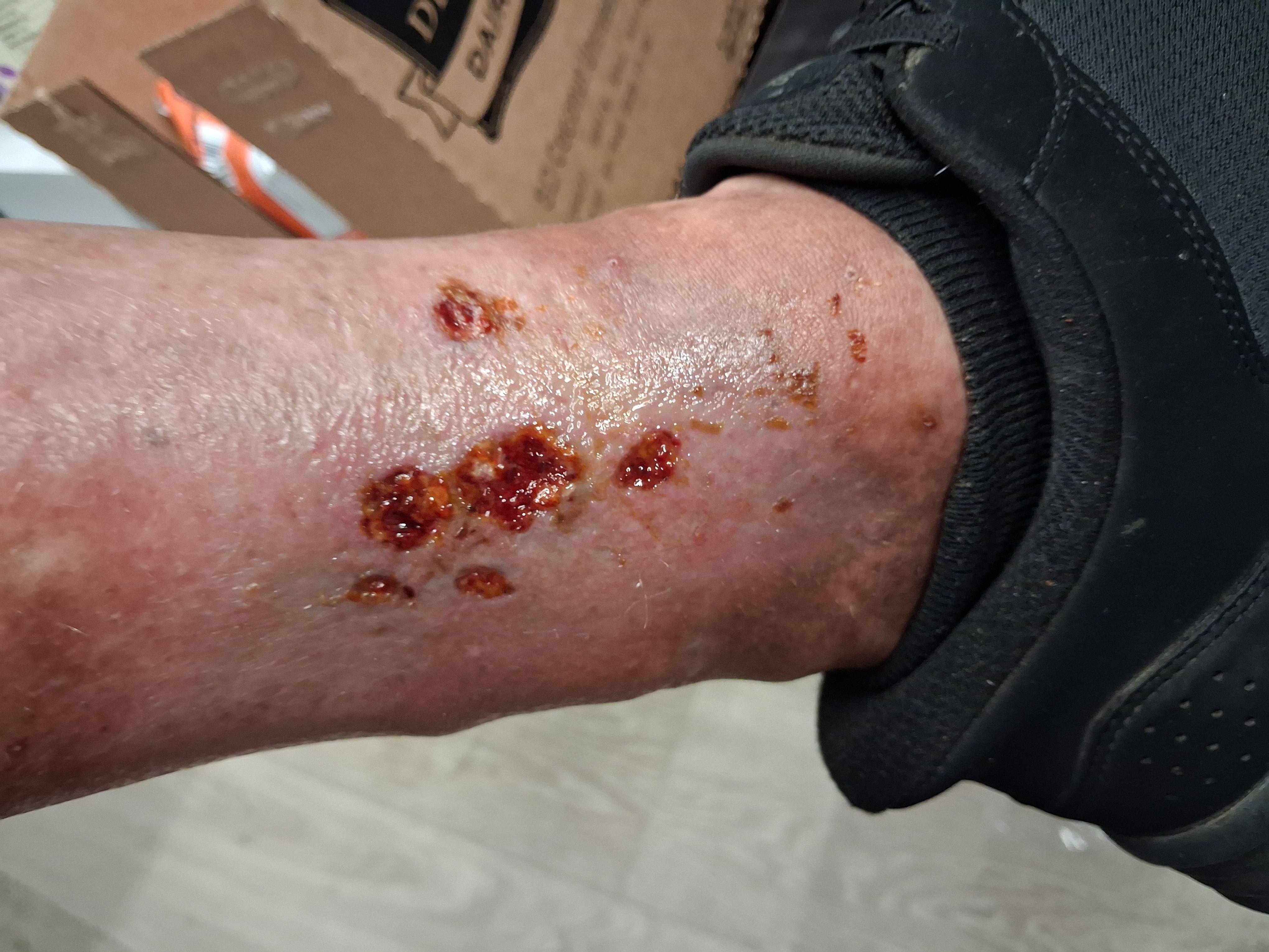 Left ankle wound, end of Week 1